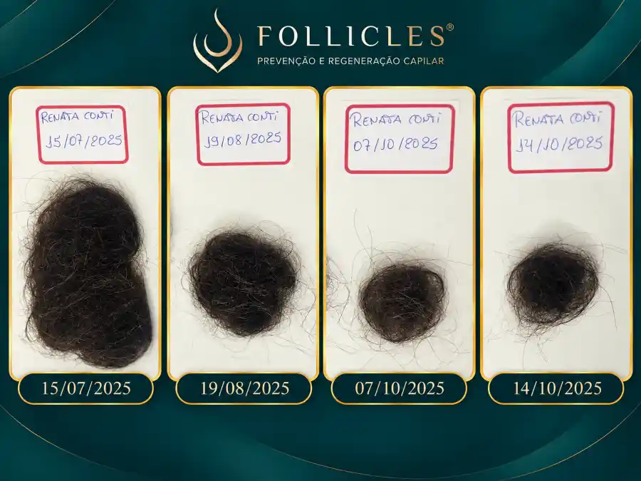 Resultado de queda capilar — paciente da Clínica Follicles, imagem 4